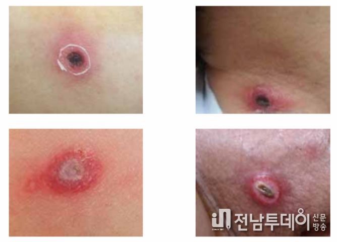 털진드기 유충에 물린 후 형성된 가피